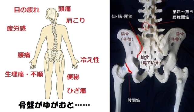 骨盤の歪み.jpg